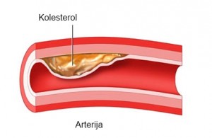 naslaga kolesterola