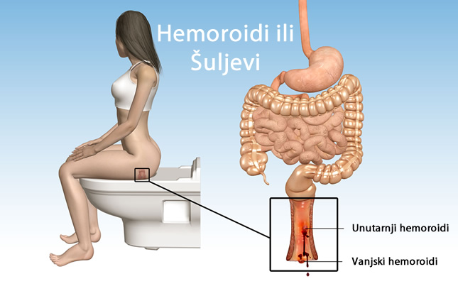 Prirodno liječenje hemoroida ili šuljeva